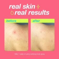 Dermalogica Clear Start Clarifying Bacne Body Spray For Acne-Prone Body Skin 177ml -Babyliss Care Shop clear start clarifying bacne body spray for acne prone body skin 177ml p33599 96287 image