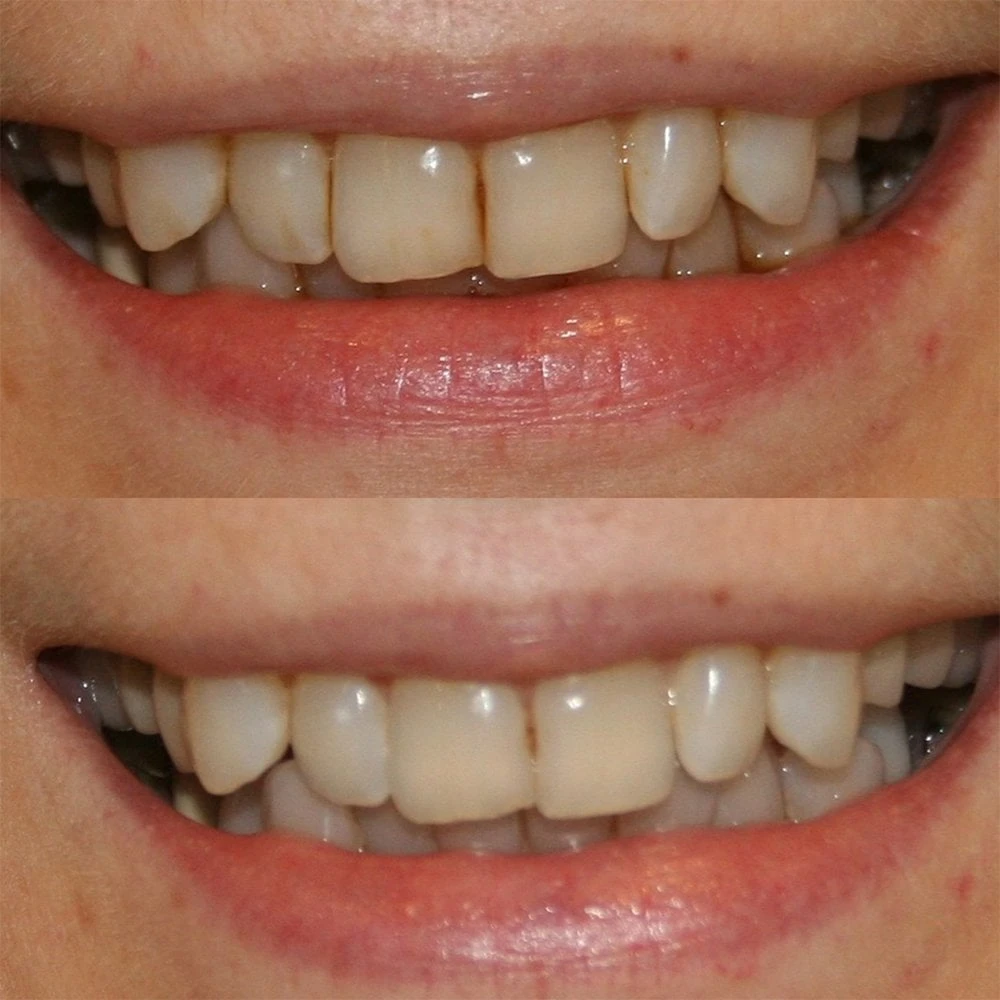 Professional Teeth Whitening Kit 10 Professional Teeth Whitening Kit - Image 8